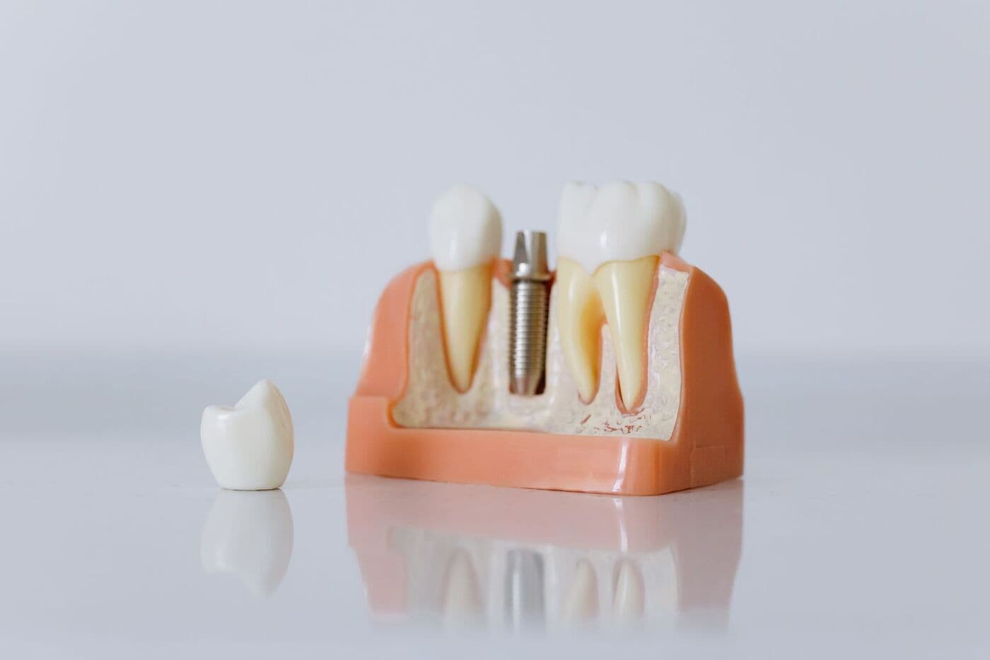 Dental implants